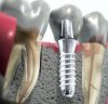Имплантация зубов. Мифы и реальность